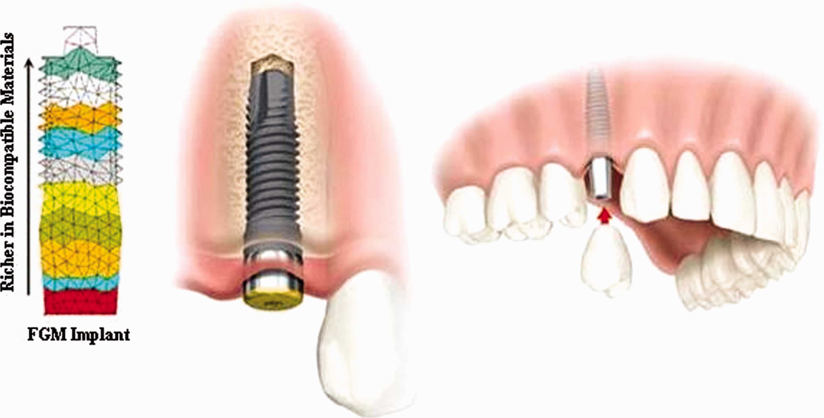 Functional Gradient Material (FGM)