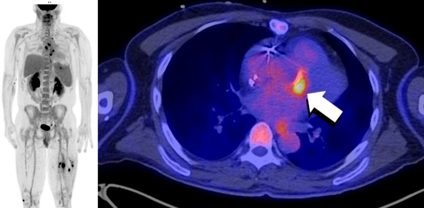 Martineau, Patrick & Grégoire, Jean & Harel, Francois & Pelletier-Galarneau, Matthieu. (2021). Assessing cardiovascular infection and inflammation with FDG-PET. American Journal of Nuclear Medicine and Molecular Imaging. 11. 46-58. 