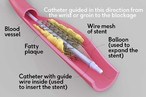 Catheters and stents