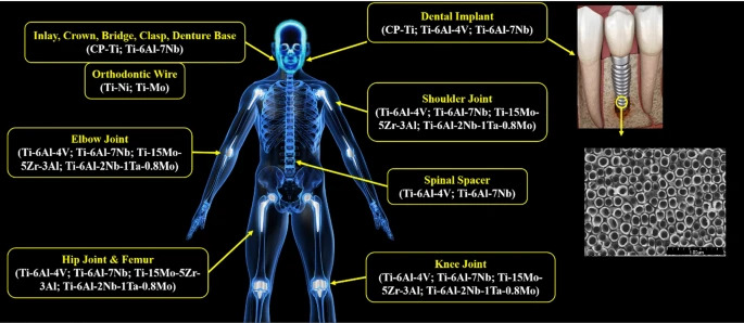 Why Titanium is the Top Choice for Medical Implants