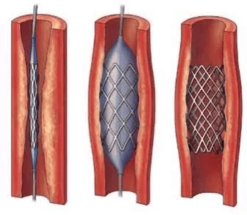 Nitinol Stent Deployment