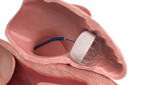 Cardiac Occluder