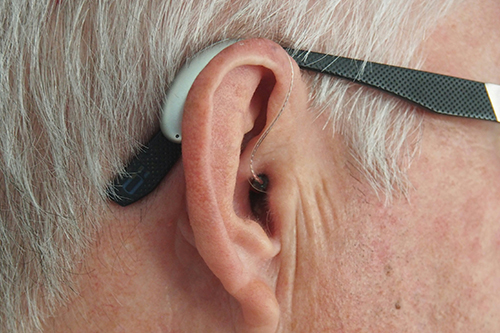 Cochlear Implants