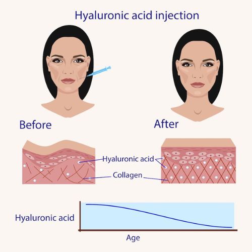 hyaluronic acid for facial filling
